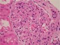 膜性増殖性糸球体腎炎ミクロ像（HE強拡大）