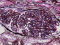 膜性増殖性糸球体腎炎ミクロ像（PAM染色強拡大）