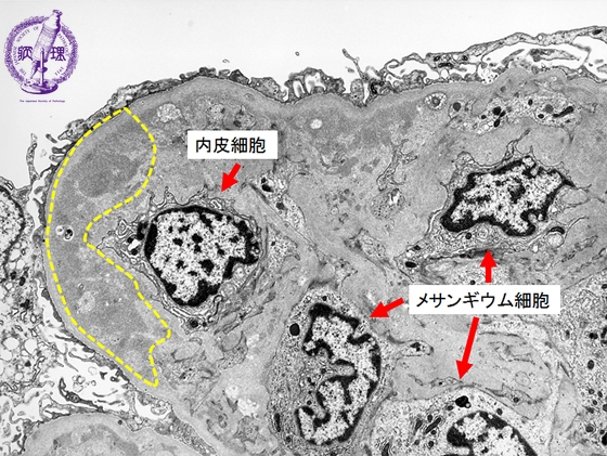 膜性増殖性糸球体腎炎電子顕微鏡像