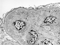 膜性増殖性糸球体腎炎電子顕微鏡像
