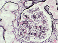 IgA腎症ミクロ像（PAM染色強拡大）