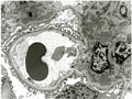 IgA腎症電子顕微鏡像