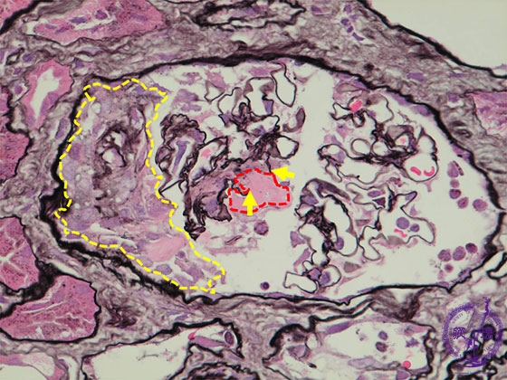 半月体形成性糸球体腎炎ミクロ像（PAM染色強拡大）