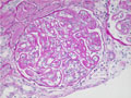 ループス腎炎ミクロ像（PAS染色強拡大）