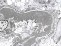 ループス腎炎電子顕微鏡像