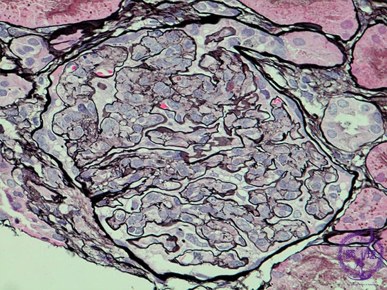 管内増殖性糸球体腎炎ミクロ像（PAM染色強拡大）