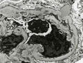 管内増殖性糸球体腎炎電子顕微鏡像