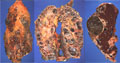 常染色体優性（成人型）多嚢胞性腎症マクロ像