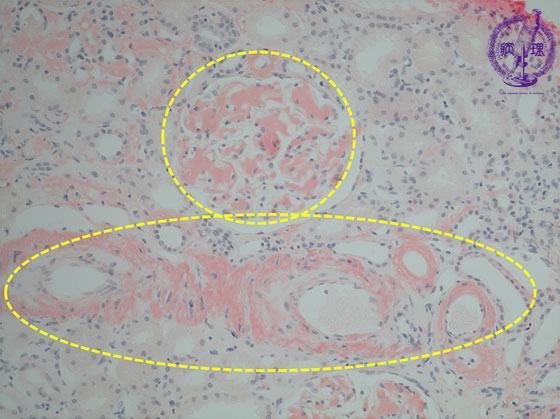 腎アミロイドーシスミクロ像（Congo-red染色中拡大）