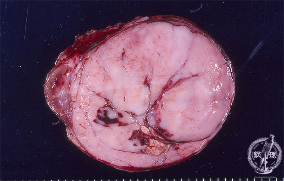 腎芽腫（Wilms腫瘍）マクロ像