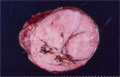 腎芽腫（Wilms腫瘍）マクロ像