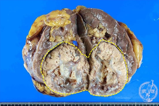 腎細胞癌マクロ像