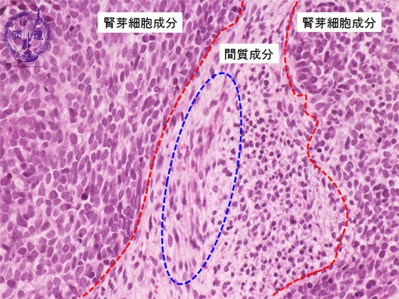 �t���iWilms��ᇁj�~�N�����iHE���g��j