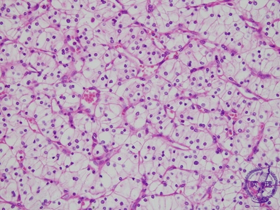 腎細胞癌ミクロ像（HE強拡大）