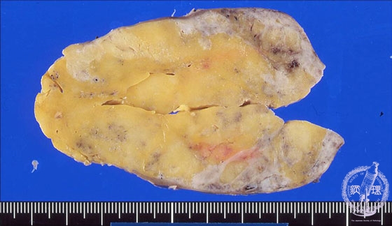 腎血管平滑筋脂肪腫（結節性硬化症）マクロ像