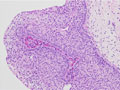 尿路上皮癌（移行上皮癌、Ｇ１）ミクロ像（HE中拡大）