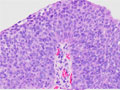 尿路上皮癌（移行上皮癌、Ｇ３）ミクロ像（HE強拡大）