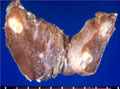 甲状腺乳頭癌マクロ像