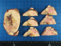 甲状腺濾胞癌マクロ像（ホルマリン固定後のスライス標本）
