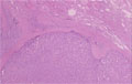 甲状腺濾胞癌ミクロ像（HE弱拡大）