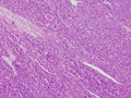 甲状腺濾胞癌ミクロ像（HE中拡大）