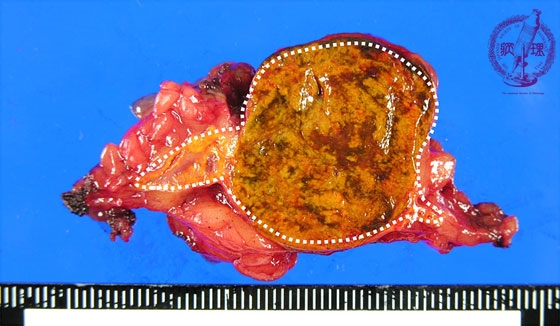 副腎皮質腺腫（クッシング症候群）マクロ像（新鮮未固定標本割面）