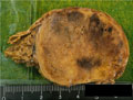 褐色細胞腫マクロ像（割面）