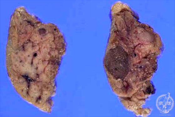 膵内分泌島腫瘍マクロ像（割面）