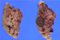 膵内分泌島腫瘍マクロ像（割面）