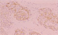 膵内分泌島腫瘍ミクロ像（chromogranin免疫染色強拡大）