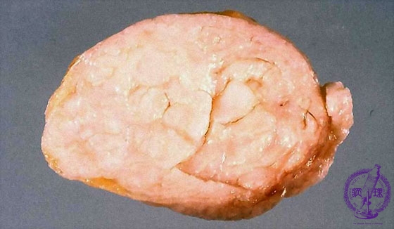 線維腺腫（管内型）マクロ像