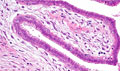 線維腺腫（管内型）ミクロ像（HE強拡大）