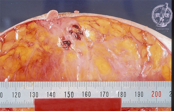 非浸潤性乳管癌（面疱型）マクロ像