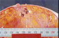 非浸潤性乳管癌（面疱型）マクロ像