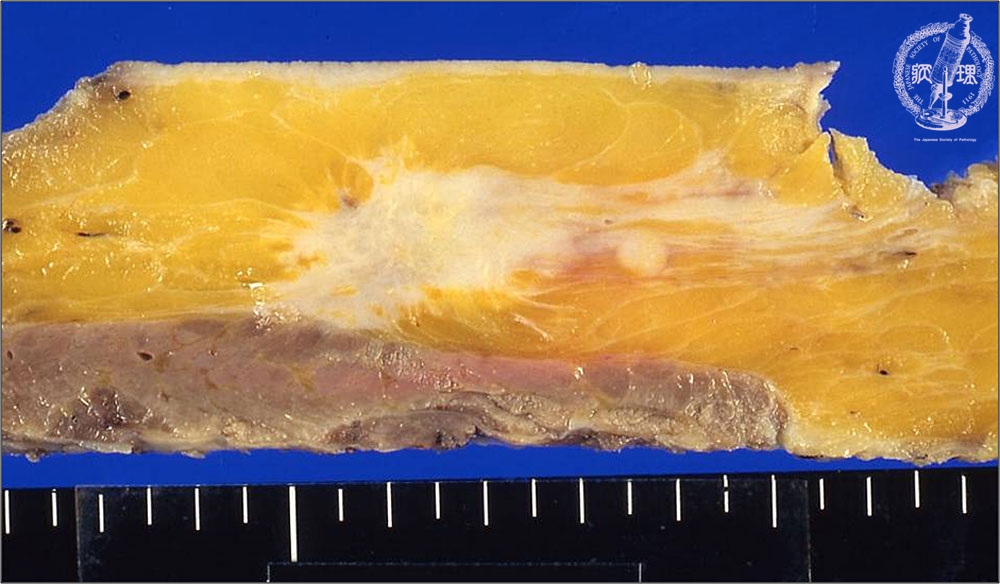 浸潤性乳管癌はどのように診断されますか?