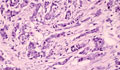 浸潤性乳管癌（硬癌）ミクロ像（HE強拡大）