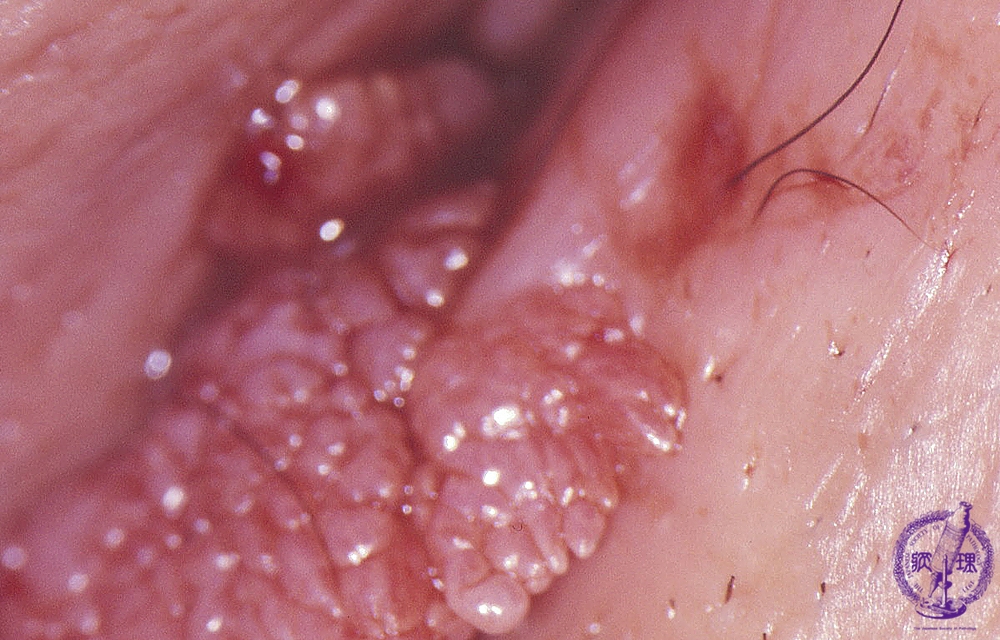 15 女性生殖器 1 外陰部尖圭コンジローマ 病理コア画像