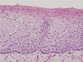 子宮頚部上皮内腫瘍（CIN）ミクロ像（HE強拡大）