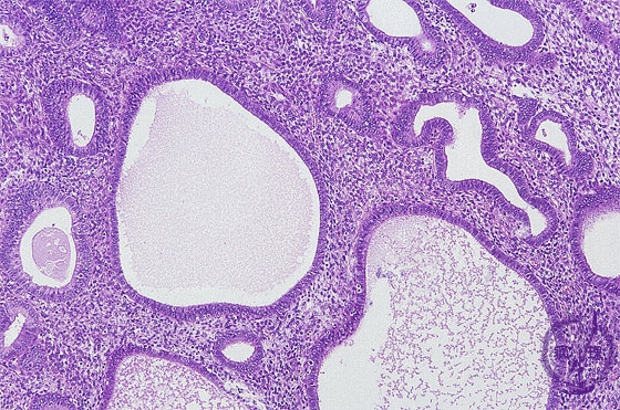 単純型子宮内膜増殖症ミクロ像（HE中拡大）
