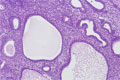 単純型子宮内膜増殖症ミクロ像（HE中拡大）