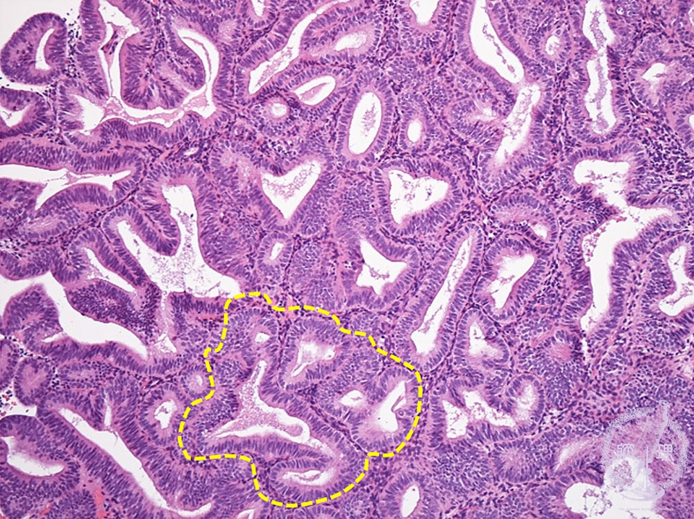 15 女性生殖器 5 複雑型子宮内膜増殖症 病理コア画像
