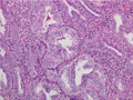 複雑型子宮内膜異型増殖症ミクロ像（HE中拡大）