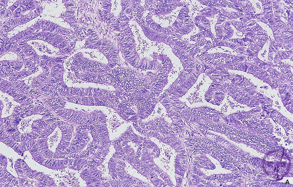 子宮頸部腺癌は治りますか？