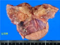 卵巣漿液性嚢胞腺癌マクロ像（未固定新鮮標本）
