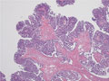 卵巣漿液性嚢胞腺癌ミクロ像（HE弱拡大）