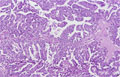 卵巣漿液性嚢胞腺癌ミクロ像（HE中拡大）