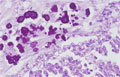 卵巣漿液性嚢胞腺癌ミクロ像（HE強拡大）
