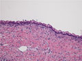 卵巣粘液性嚢胞腺腫ミクロ像(HE強拡大）