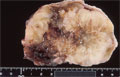 卵巣粘液性嚢胞腺癌マクロ像
