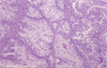 卵巣粘液性嚢胞腺癌ミクロ像（HE中拡大）